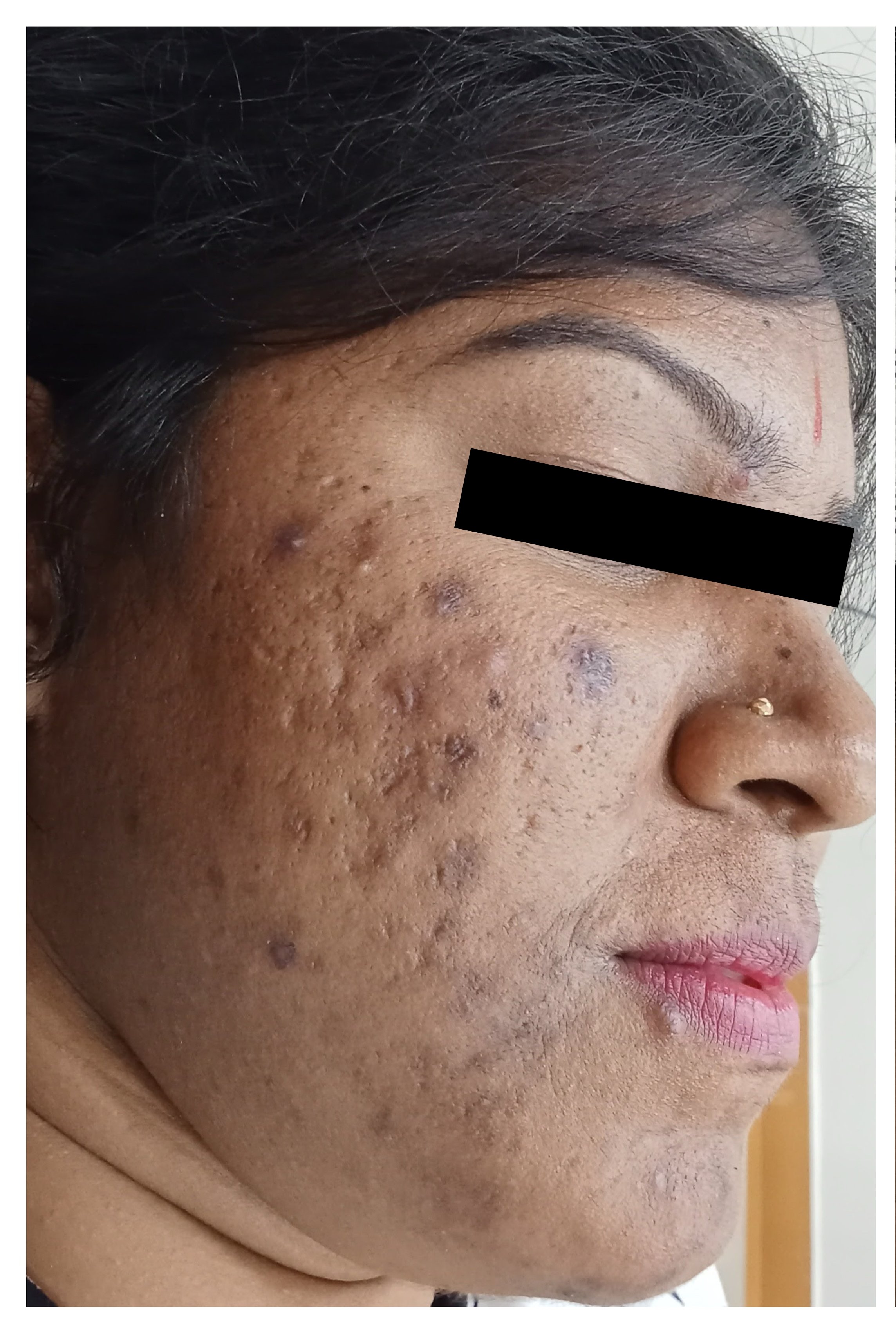 Before Laser Hair Removal